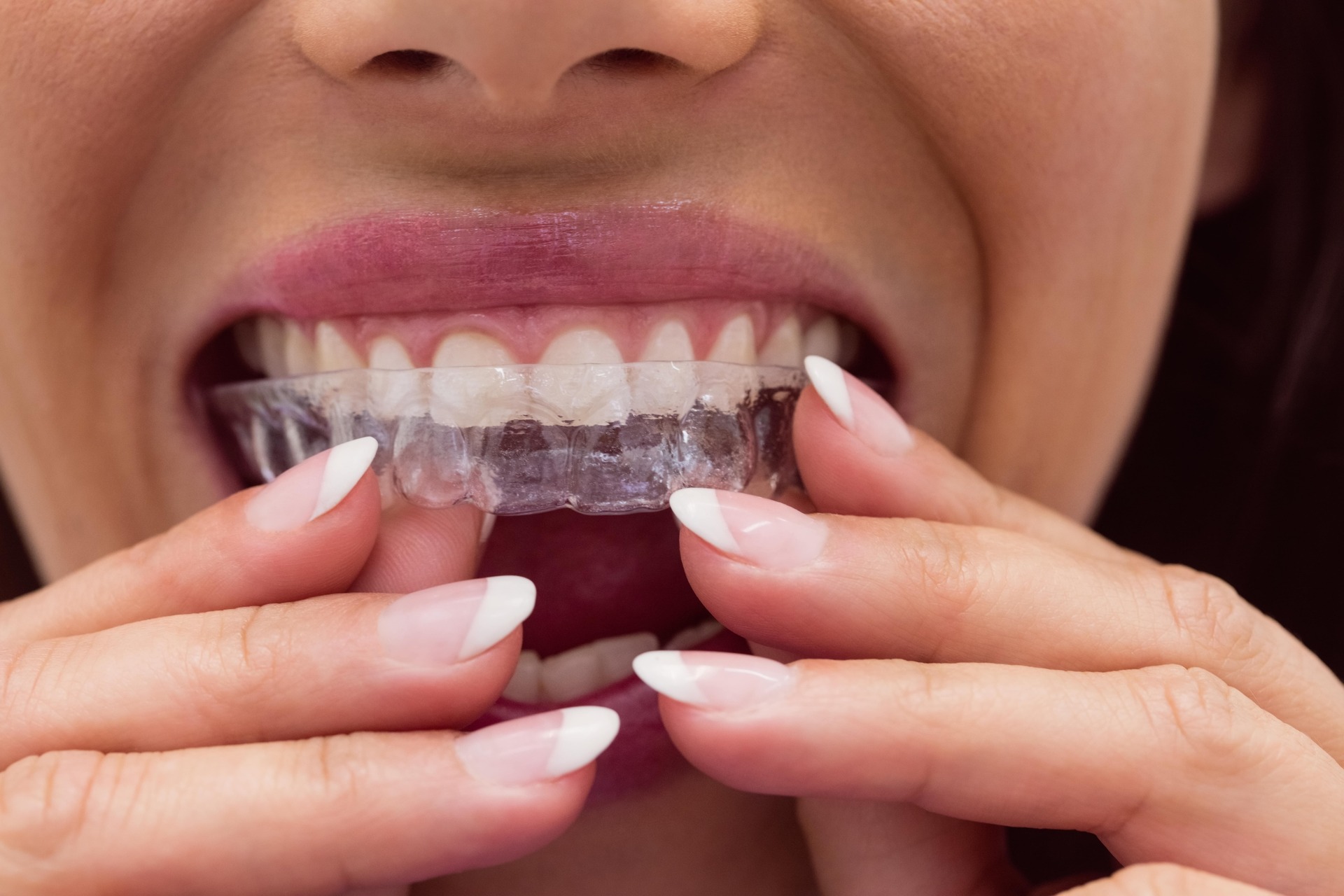 Close-up of a woman inserting clear aligners over her teeth for invisible orthodontic treatment.