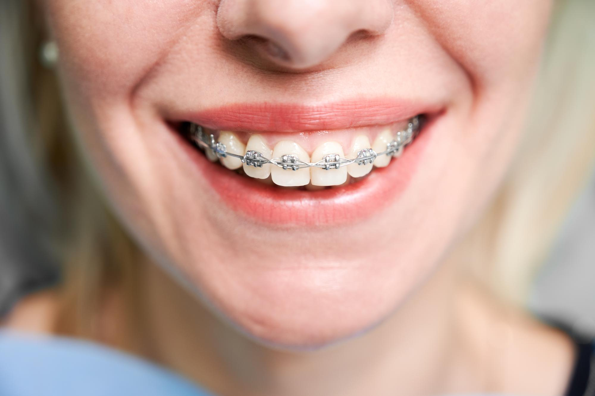 Close-up of a smiling woman wearing traditional metal braces on her teeth.