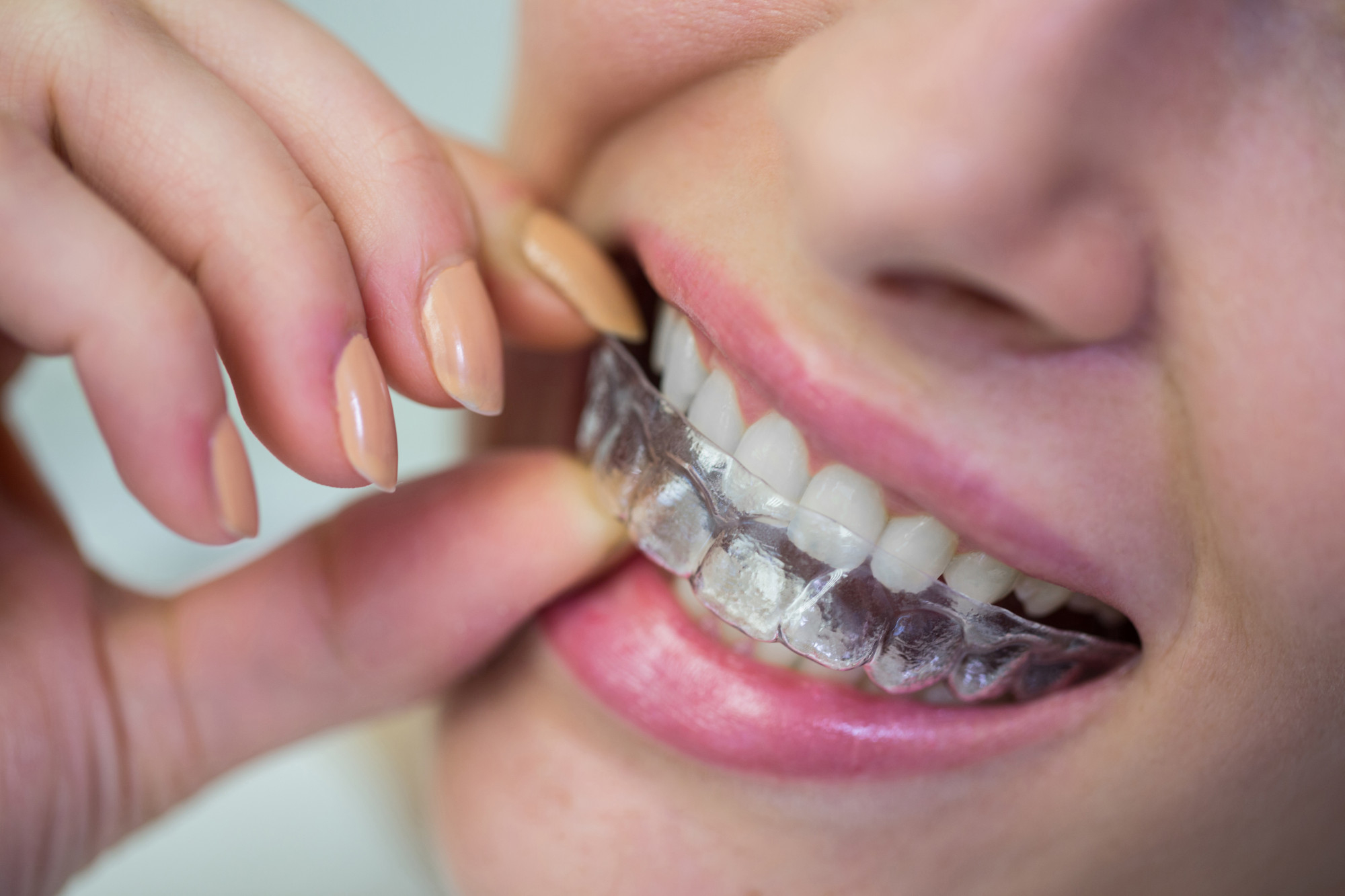 Close-up of a smiling woman placing orthodontic clear aligners on teeth for invisible braces treatment.