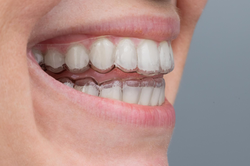 Fixing overbite with aligners
