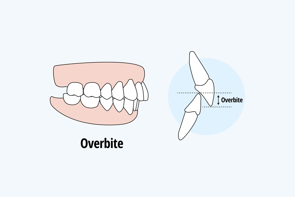what is overbite
